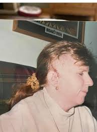 25 Years Ago Today I Had Brain Surgery to Remove The Brain Aneurysm that  Ruptured