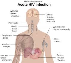 Image result for skin rash acute hiv infection