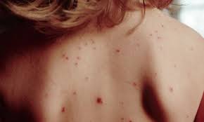 Image result for Measles