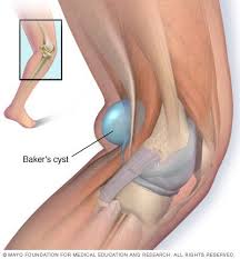 Baker S Cyst Baker S Cyst Knee Arthritis Bakers Cyst Treatment