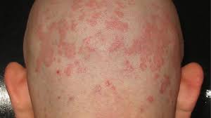 Image result for white scabs on the head in children