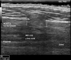 Muscle Hernia Radiology Reference Article Radiopaedia Org