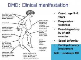 Didier morain distribution (french pet supply company) dmd: Duchenne Gait Physiopedia