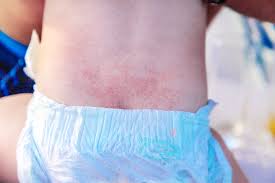 Image result for sweat rash on back