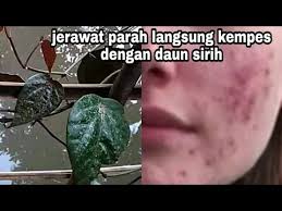 Check spelling or type a new query. Cara Mengobati Jerawat Dengan Daun Sirih