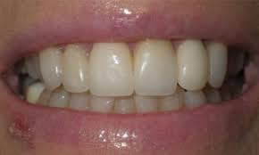 Porcelain Veneers Teeth Porcelain Veneers Near Me North