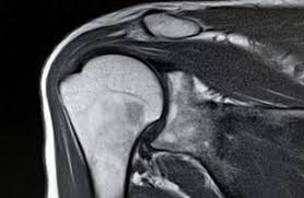 Rotator cuff strain is a tear to one of the rotator cuff muscles in the shoulder. Bursitis Of The Shoulder Symptoms Treatment And Exercises
