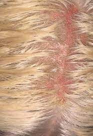 Your skin won't be very happy with you after you use any kind of bleach on it. Student S Hair Falls Out In Clumps After Hairdresser Leaves Bleach On For An Hour Daily Star