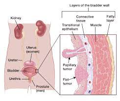 This is called microscopic hematuria. What Is Bladder Cancer