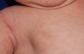 Image result for Galactorrhea