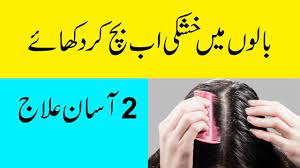 Hair dandruff treatment in urdu balon ki khushki ka ilaj. Dandruff Remedies At Home Naturally In Urdu How To Remove Dandruff Fro Dandruff Remedy How To Remove Dandruff Dandruff