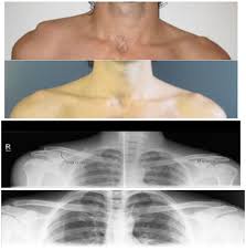 Image result for AC Dislocation