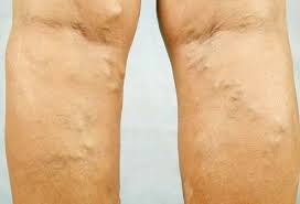 Sometimes they are swollen and raised above the surface of the skin, usually appearing on the backs of the calves or on the inside of the leg. Spider Varicose Veins Causes Before And After Treatment Images