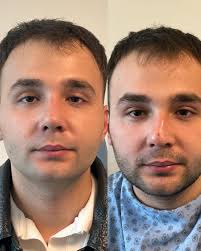 septorinoplasti sonrası 1.ay kontolümüz #rinoplasti #rhinoplasty  #piezorhinoplasty