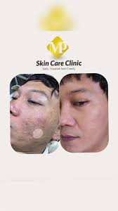 Review Treatment untuk Mengatasi Pori Besar dan Scar Acne