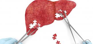 Its stages are 0, a, b, c, and d. Hiv And Your Liver Poz