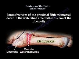 You should be able to return to most activities in about six months. Jones Fracture Proximal Fifth Metatarsal Everything You Need To Know Dr Nabil Ebraheim Youtube