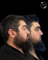 РИНОСЕПТОПЛАСТИКА. Результат через 10 месяцев Путь к вашей мечте лежит  через мои знания и опыт. Ваш доктор Али. Записаться на консультацию можете,  написав в директ или на вотсап, по номеру: 8-926-732-20-10. Менеджер