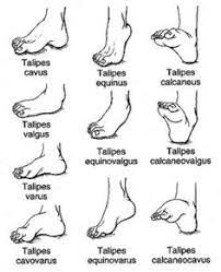 Club foot or clubfoot, also called congenital talipes equinovarus (ctev), is a congenital deformity involving one foot or both. 32 Clubfoot Ideas Club Foot Club Foot Baby Pediatric Physical Therapy