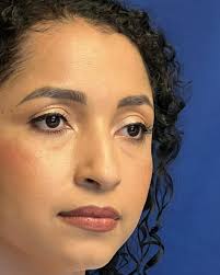 RINORECONSTRUCCION, resultado, apenas 12 días después de su cirugía.