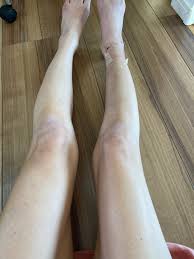 足首 骨折 ブログ