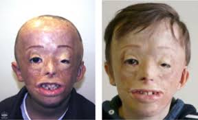 Villarreal page) and competitions pages (champions league, premier. Narben Und Brandwunden Bei Haartransplantationen Hsi