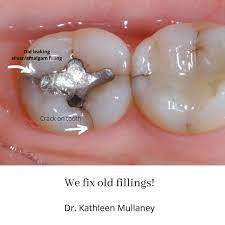 Do You Have Old Silver Fillings Tooth Colored Fillings Dental Cosmetics Dentist In