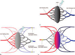 Learn all about the anatomy and physiology of the human heart with an interactive diagram and detailed descriptions of the organ and its parts. Treatment Of Vascular Malformation A Diagram Shows A Simple Vascular Download Scientific Diagram