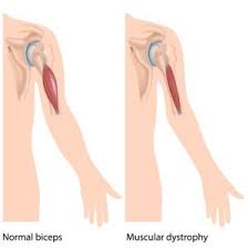 The clavicular head attaches to the medial portion of the clavicle. Genethon Sarepta Partner For Gene Therapy For Muscular Dystrophy