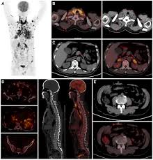 Chronic obstructive pulmonary disease (copd) is the fourth leading cause of death in the united states ().in addition to the irreversible airflow obstruction that characterizes the disease, copd is recognized as a systemic inflammatory disorder with numerous additional pulmonary and extrapulmonary manifestations, including an increased risk for development of primary lung cancers (). Cutaneous Metastasis As The First Presentation Of Non Small Cell Lung Ott