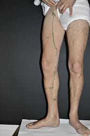 Behandlung Von Krampfadern Mit Skalpell Hitze Oder Laser Doctors Today