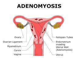 Check spelling or type a new query. Adenomyose Endometriose Stichting