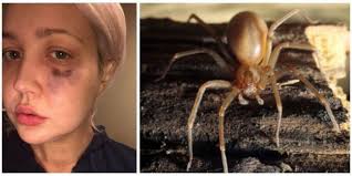 Basic, black, blackwidow, brown, brownrecluse, c, c++. Brown Recluse Spider Bite Facts Meghan Linsey Bitten By Poisonous Brown Recluse Spider