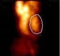 Image result for Nuclear Ventriculogram