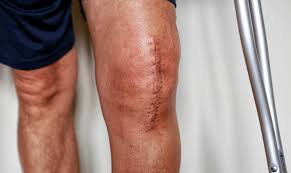 We did not find results for: How Long Do Knee Replacements Last The Truth Spring Loaded Technology