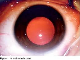 Image result for Red Reflex