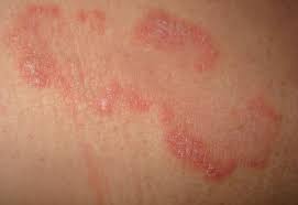 Buna fetelor, fetita mea de vreo saptamana si jumatate are chiar daca nu il lasi prea mult timp u orice copil care are pielea sensibila. Ce Poate Provoca O Eruptie Cutanata Dupa O Febra La Copii Mici Buna Ziua Iasi Bzi Ro