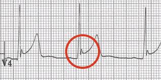 Image result for Early Repolarization