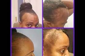 Regrow Your Bald Hair Fast X2f Treat Thin And Bald Hair Youtube Thin Hair Help Treat Damaged Hair Black Women Hair Loss