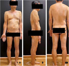 Image result for Anhidrosis