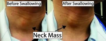 Check spelling or type a new query. Thyroid Nodule Overview The Thyroid Exam Stanford Medicine 25 Stanford Medicine