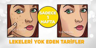 Yuzdeki Lekeleri 1 Haftada Yok Eden Tarifler Dogal Cilt Bakimi Cilt Bakimi Dogal Cilt