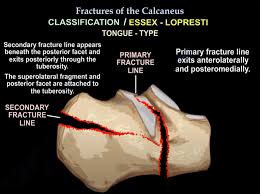 Image result for Calcaneus Compression Fracture