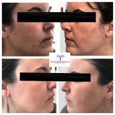 Medspa can be performed on your upper lip & chin, bikini line, legs, and back. Nova Derm Institute Aather0029 Profile Pinterest