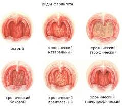Bol V Gorle Otdaet V Uho Prichiny Simptomy I Lechenie