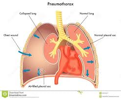Abnormal presence of air in the pleural cavity types of pneumothorax: Pneumothorax And Physiotherapy Management Mobile Physiotherapy Clinic