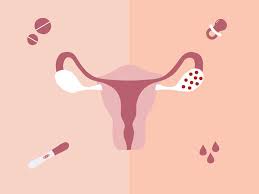 Pcos is a leading cause of female infertility. Yesmom Top 5 Pcos Myths That Need To Be Debunked