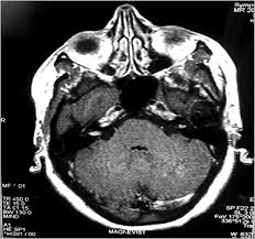 We do the middle ear surgery for otosclerosis but the noise has persisted. Incidental Findings On Magnetic Resonance Imaging In Patients With Tinnitus Kalsotra P Gupta R Gupta N Sharma R Gupta S Gupta Gd Indian J Otol