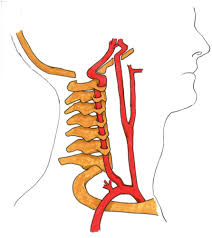 Estos casos son los que algunos autores llaman suspensión, y son aquéllos en los cuales se cuelga o sus­ Manipulacion Cervical Y Riesgo De Diseccion Arterial Noticias Medicas Intramed