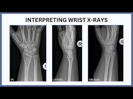 Image result for Wrist XRay